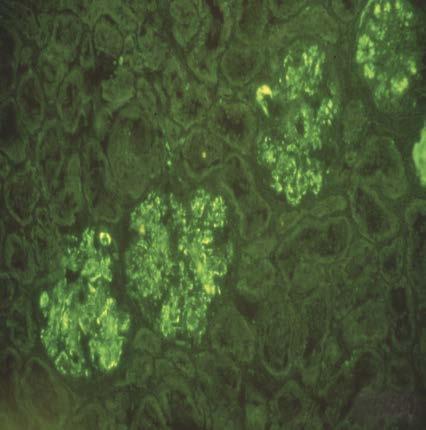 MPGN associated with complement dysregulation C3 nephritis factor Genetic Factor H deficiency (mouse, pig, dog, man) Autoantibody to