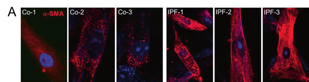 Fig. 11. IPF fibroblasts retain their fibrotic phenotype in cell culture. (A) Single immunofluorescence of the fibrotic marker -SMA in control and IPF fibroblasts.