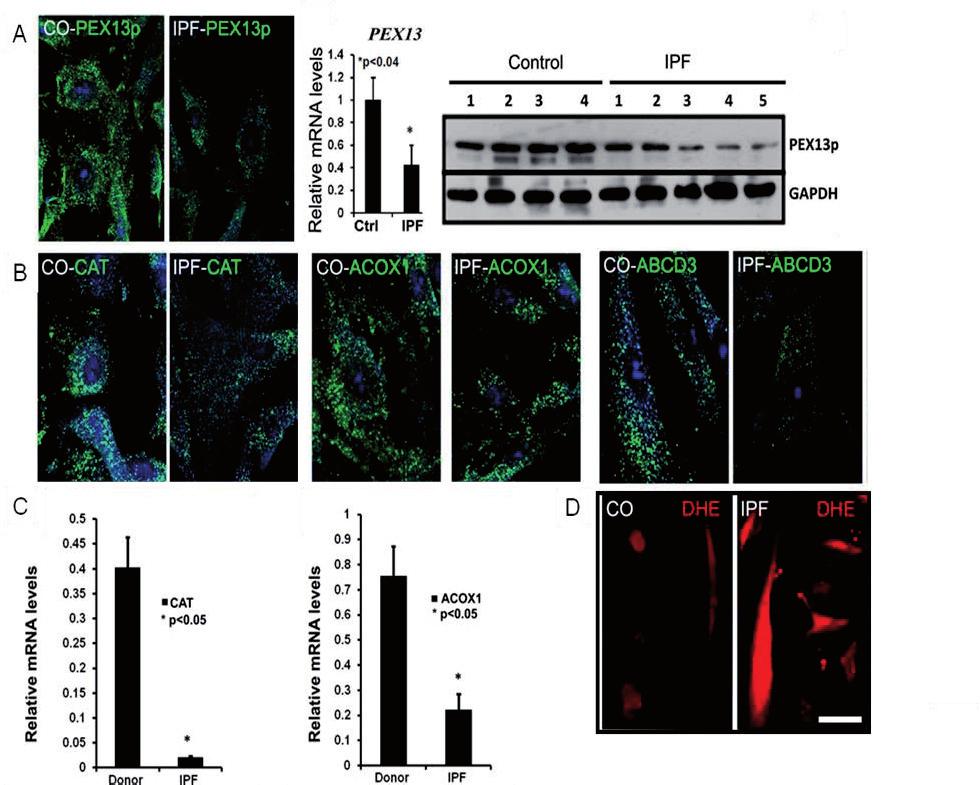 Downregulation of catalase and ACOX1 in IPF fibroblasts were also demonstrated at mrna level (Fig. 12C).