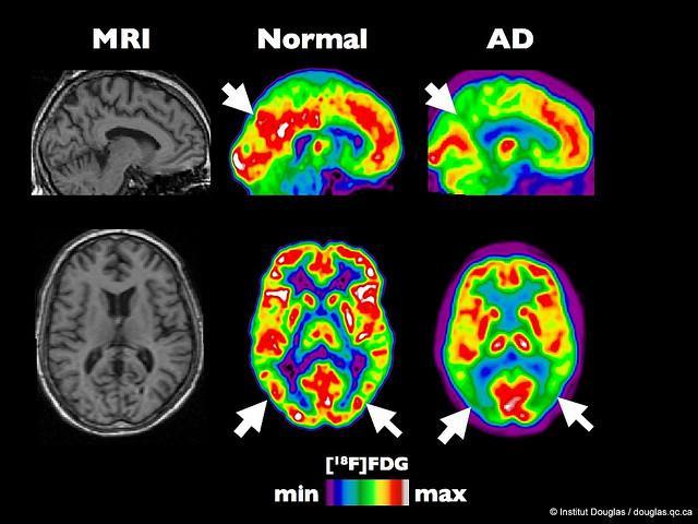 Rotterdam Scan Study Based on MRI, hippocampus and