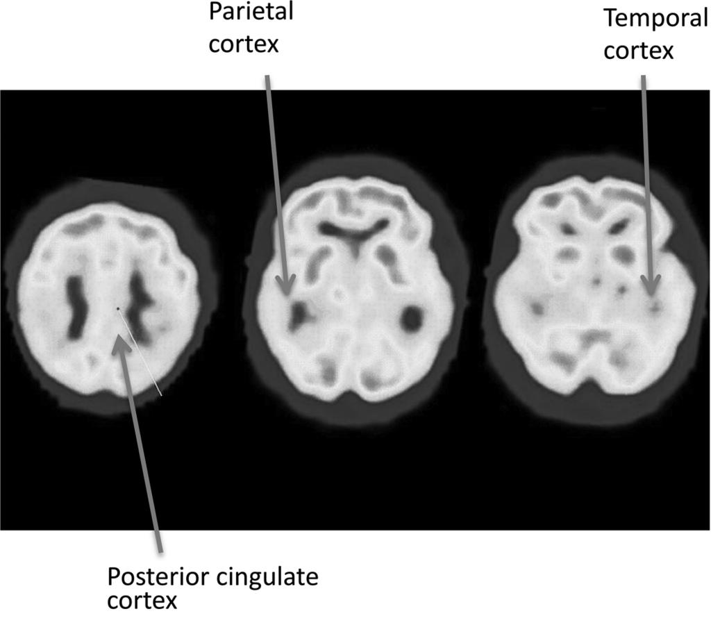 Toney et al Two small retrospective studies of MCI suggest that hypoperfusion in parietal and temporal lobes on perfusion SPECT may occur very early in AD; however, these ﬁndings should be replicated
