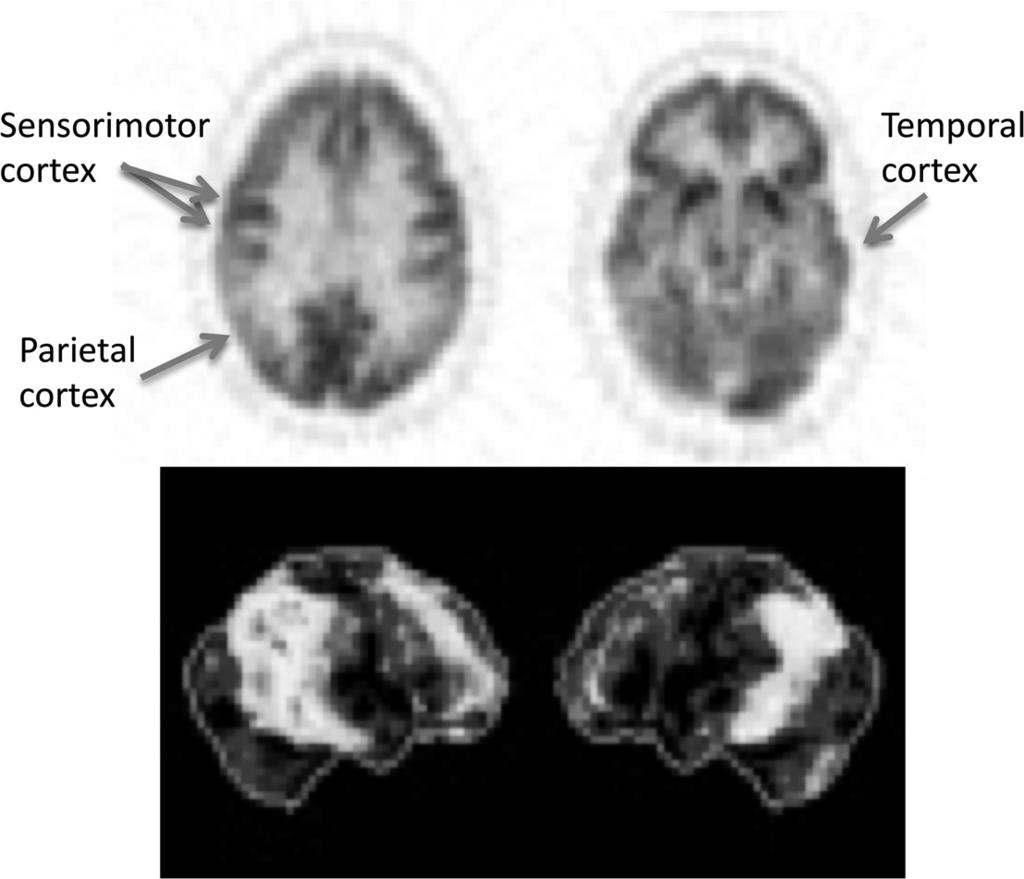 45 The largest difference was seen in cases of mild dementia, with the implication that perfusion SPECT with 3D-SSP may have a unique role in early AD detection.