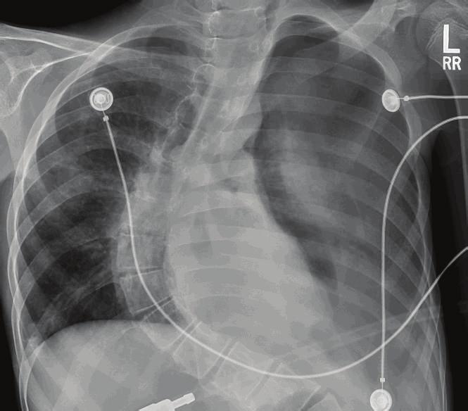 2 Case Reports in Critical Care Figure 1: CXR showing left side pneumothorax and pleural effusion. Expansion of the left lung, chest tube, and left sided effusion.