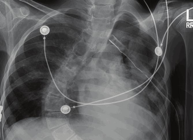 Other findings on physical examination included decreased air entry on the left hemithorax, quadriparesis, and slow mentation. Chest X-ray (CXR) revealed large left hydropneumothorax (Figure 1).