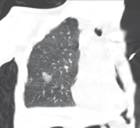 Case Reports in Critical Care 3 Figure 2: Chest CT different cuts from lung showing right side