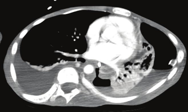 4 Case Reports in Critical Care Figure 3: Chest CT with wide window width: mediastinal window, lung window showing esophageal tear and communication with pleura (red arrow).