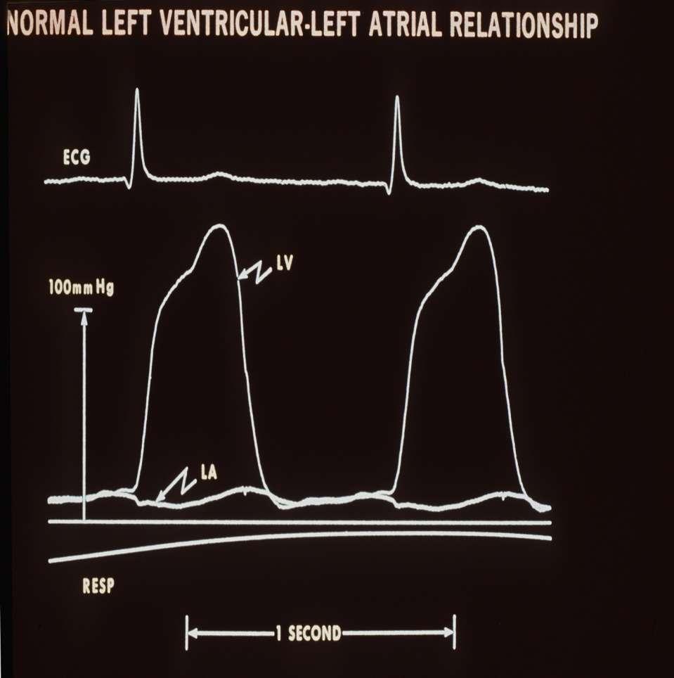 Normal Left Ventricular