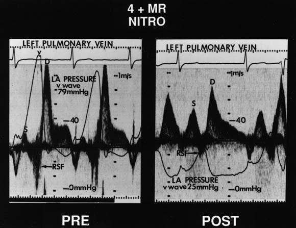 TEE in patients with MR, looking at correlation of V wave and LA pressure