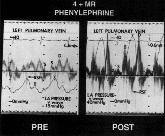 TEE in patients with MR, looking at correlation of V wave and LA pressure