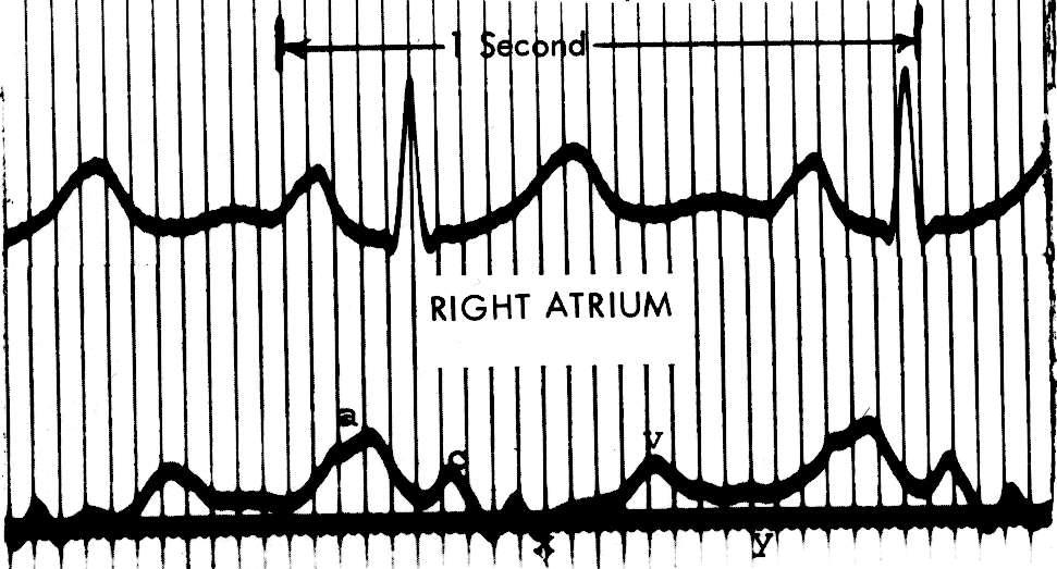Normal RA Pressure Waveform Criley