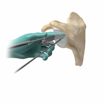 Slots in the guide are provided for visualization if the glenoid has been sectioned into quadrants by using a bovie. Insert the 3.