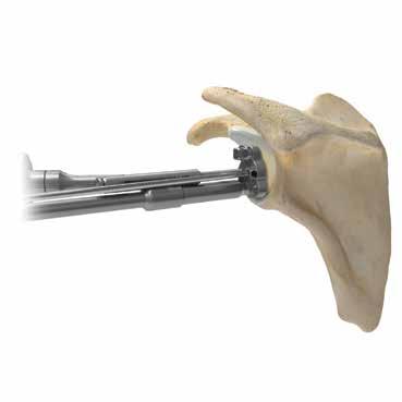 Access Cannulated Glenoid Technique Figure 35 Insert a quick-release drill into the quick-release driver. Drill the superior hole until the stop is engaged.