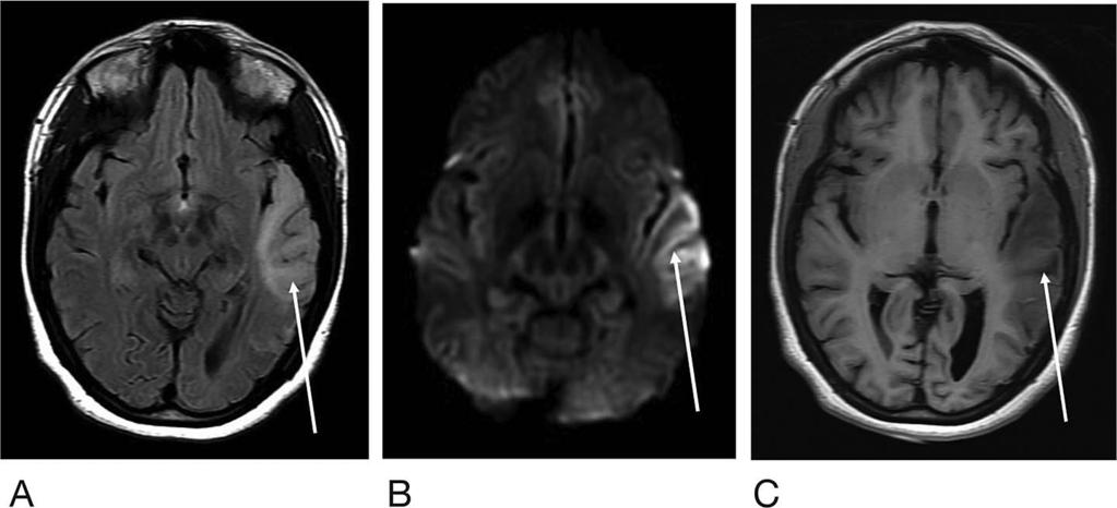 inversion recovery (T2-FLAIR) hyperintense signal (A), corresponding diffusion weighted imaging signal abnormality (B), and T1 hypointense signal (C).