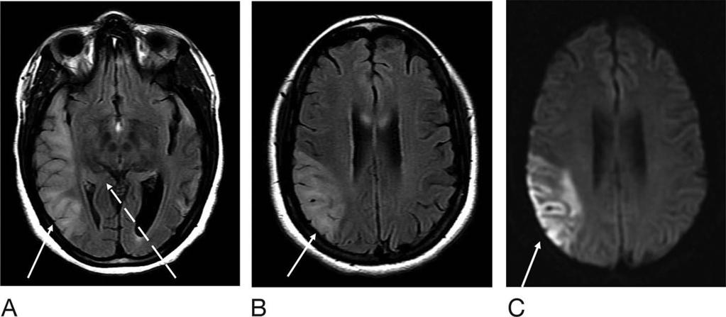 MELAS Syndrome Figure 6. Magnetic resonance imaging of the brain 9 months after the patient s initial presentation at the level of the cerebral peduncles (for comparison with Figures 2 and 3).