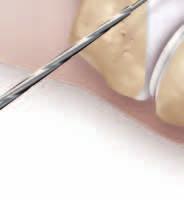 GRAFT SELECTION 1 A gracilis autograft is used, as the size and strength has been shown to be sufficient for MPFL reconstruction (approximately 4 mm in diameter).