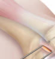 PREPARATION OF THE PATELLA 2 Palpate the medial patellar border and make a 2 cm skin incision from the superomedial corner, extending to the center of the medial