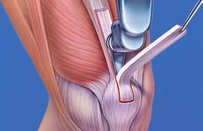A special harvesting system for the quadriceps tendon allows subcutaneous tendon removal via a minimal skin incision.