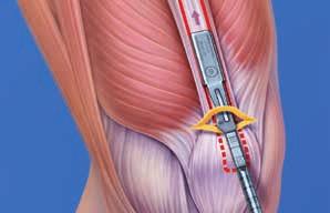 For cruciate ligament reconstruction, an oscillating saw can be used to harvest a bone block from the proximal patella in the appropriate width and thickness.