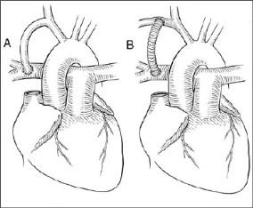 Approach Operative stages for achieving a Fontan circulation: 1.