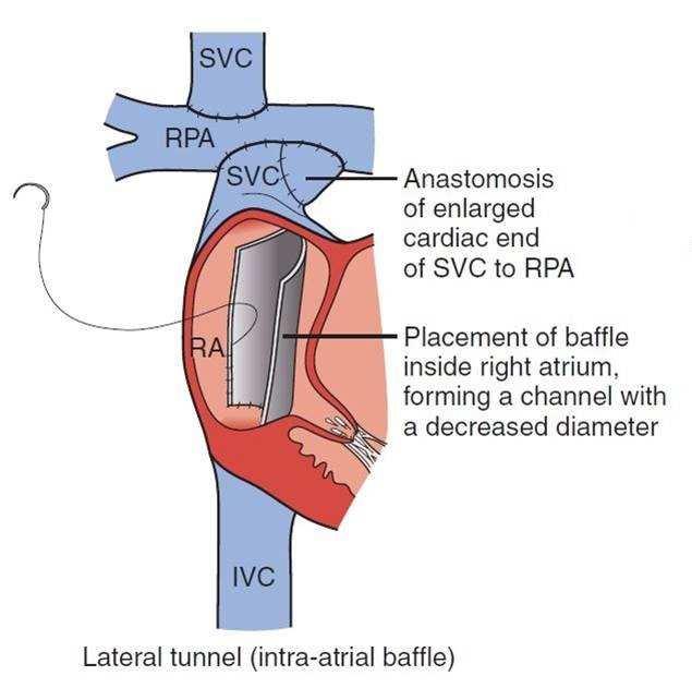 The modern Fontan operation: Lateral Tunnel Fontan improved pulmonary blood flow only the lateral wall of the atrium is exposed to