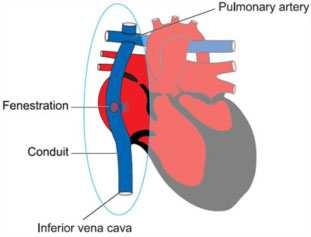 Complications Short term complications after Fontan pleural effusions (25%) o fenestration from the venous circulation atrium When the pressure in the veins is high, some of the oxygen-poor blood can