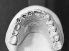 Note the bone irregularities and undercuts in the area of desired implant placement,