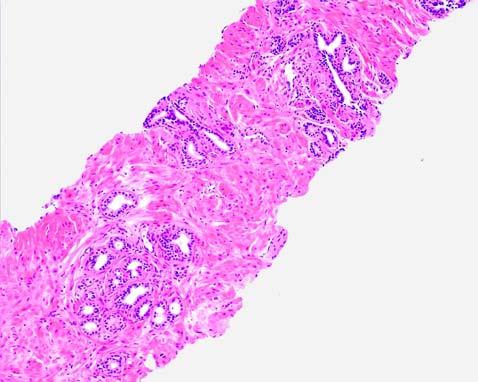 phy and atrophy with no inflammation to adenocarcinoma.