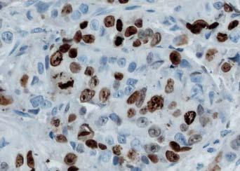 .. reported upon a new monoclonal antibody which was generated by immunizing mice with nuclei of the Hodgkin lymphoma line L428. The antibody labelled nuclei of proliferating s including tumor s.