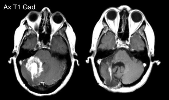 5 months 40 Yes 4 10 Figure 1: Patient 1: MRI scans post contrast shown pre and post-treatment. Preand post-treatment scans were taken 3 months apart.