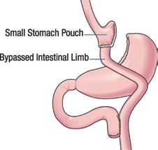 Surgical Options Laparoscopic Roux-en-Y Gastric Bypass With more than 200,000 performed annually in the United States, the Laparoscopic Roux-en-Y Gastric Bypass is the most frequently used and