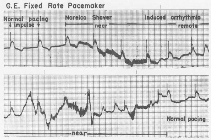 The entire frequency response of the pacemaker was the narrowest of any of the tested units. Cordis Bentricor Z. This pacemaker, similar in mode of operation to the American Optical Co.