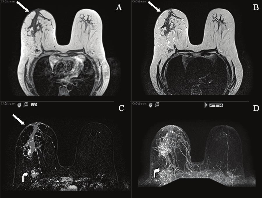 29 Figure 3. MR images (T1, T2, post-contrast subtracted and MIP) demonstrating a large segmental area of heterogeneous enhancement in the right central breast.