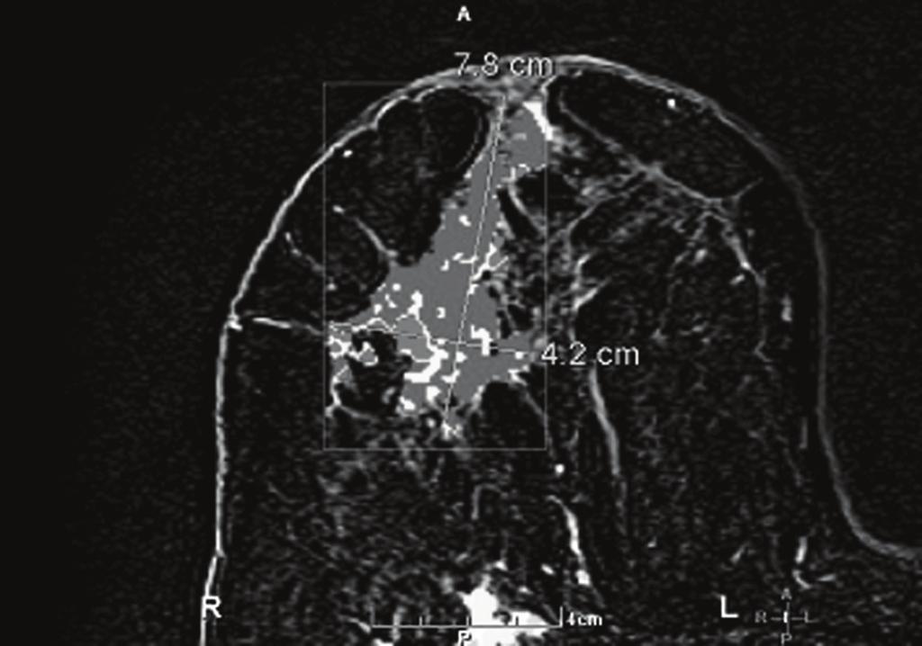 Significant right axillary lymphadenopathy is also present (curved arrow). 4,051 breast cancer patients found an overall incidence of primary gynecologic cancers metastatic to the breast of 0.