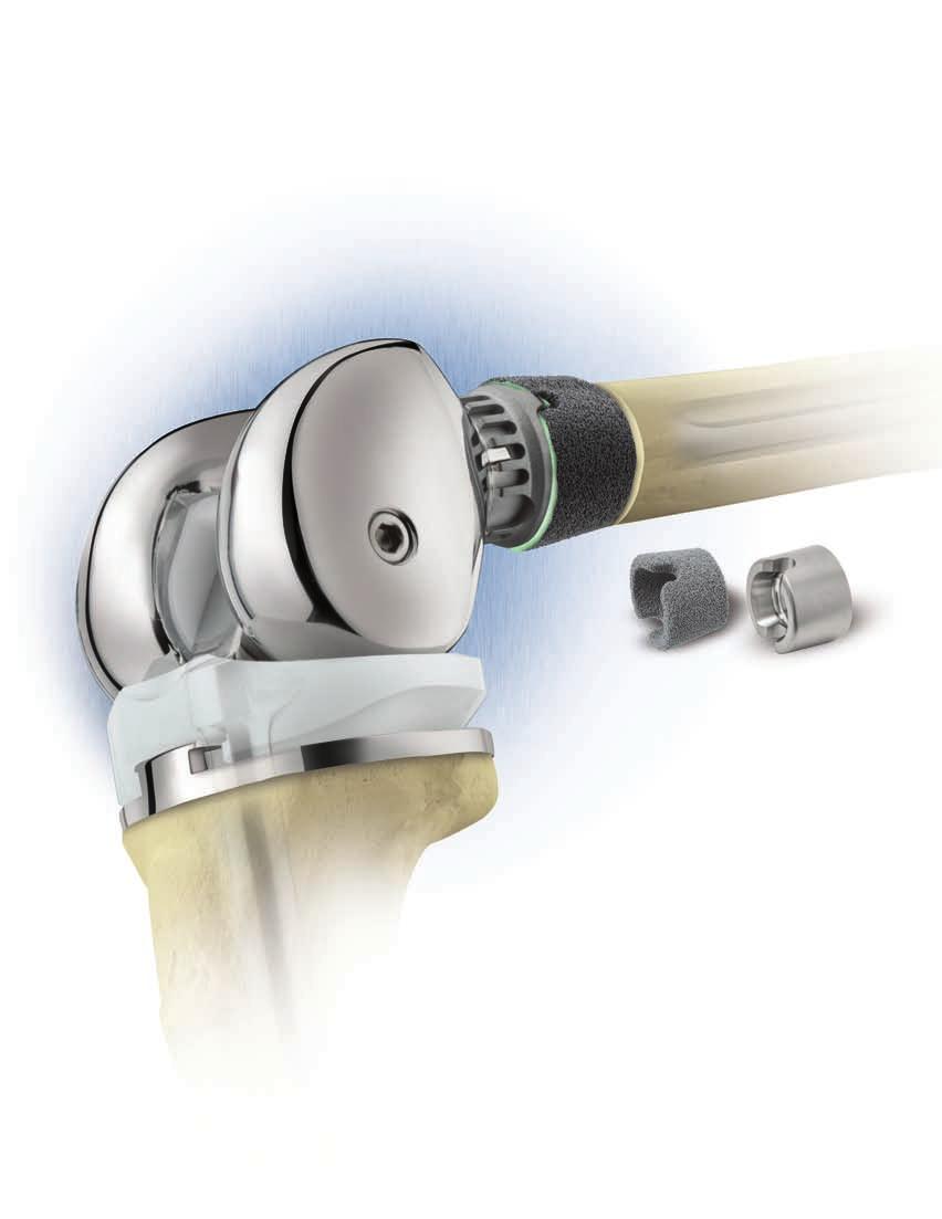 Flexibility. Fixation. Bearing Options. The Segmental System utilizes many Zimmer technologies to address severe bone loss from disease, trauma or revision.