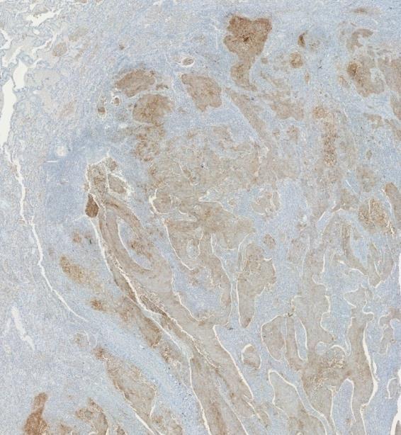 PD-L1 expression (IHC) as a predictive biomarker Different antibodies E1L3N 3 SP142 3 SP263 3 Similar results with 3