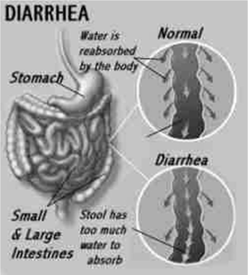 Disorders of the digestive disorders Diarrhea Define diarrhea.