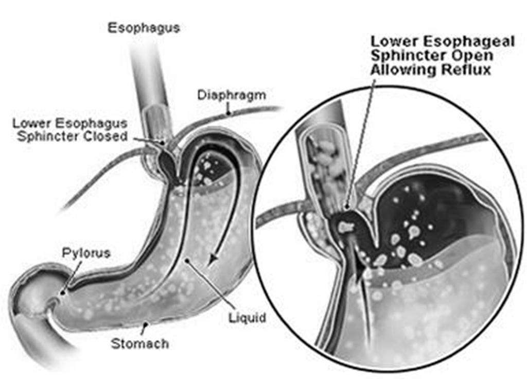 Disorders of the digestive system Gastroesophageal reflux disease