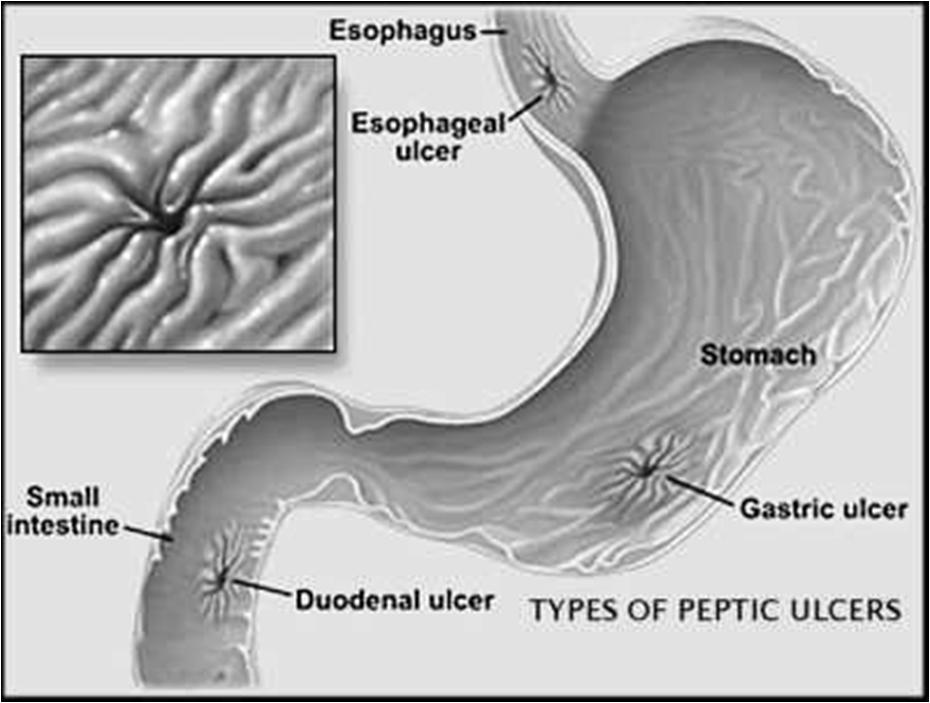 Disorders of the digestive system Peptic ulcer What is a peptic