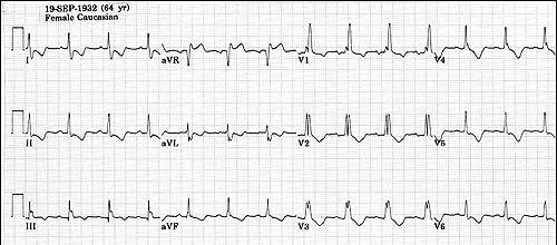 notched R wave in V