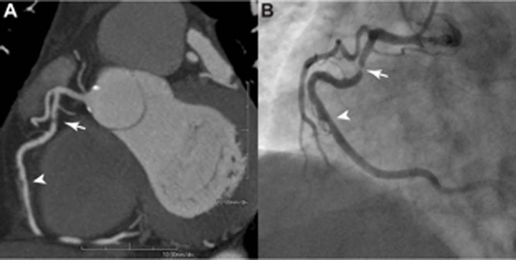 90 Current Cardiology Reviews, 2012, Vol. 8, No. 2 Fernandez-Friera et al. Fig. (1). Cardiac computed tomography study and invasive coronary angiography on the same patient.