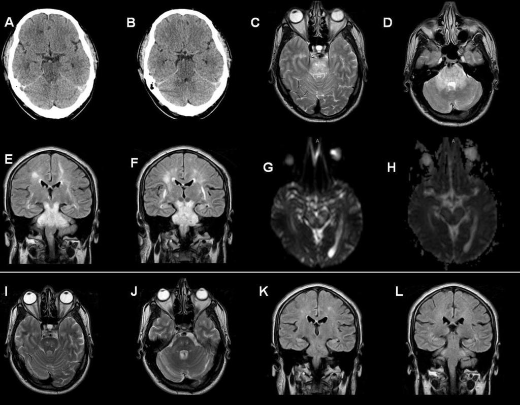 Fig. 4: PRES. Atypical presentation in a 40 year-old-man with hypertensive emergency. Non-contrast brain CT (A, B) shows swelling and marked hypodensity of the pons.