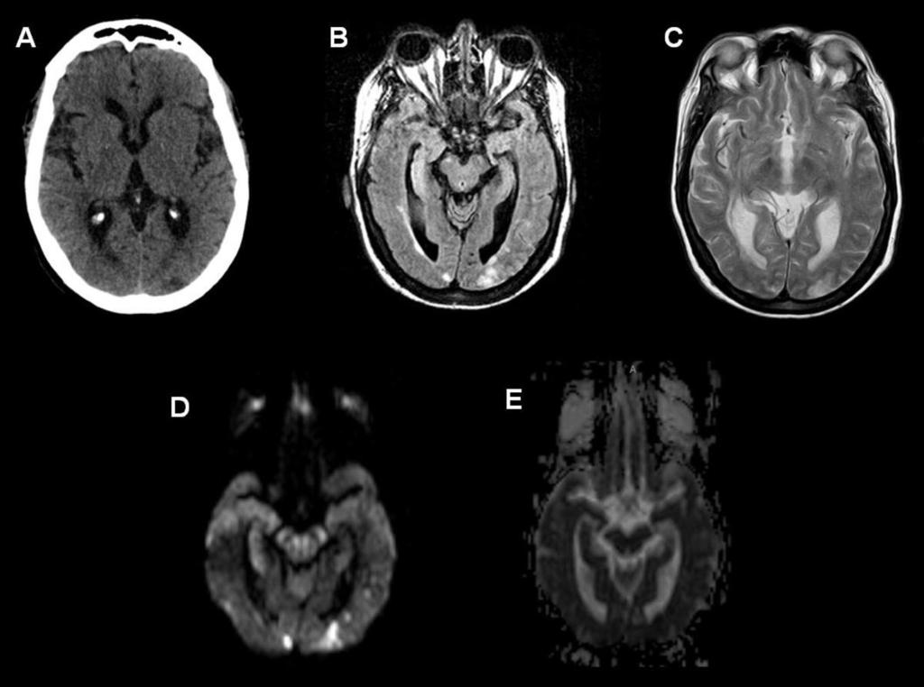 Fig. 6: Basilar top infarction. Non-enhanced brain CT scan on admission (A,B) shows sulcal effacement and bilateral hypodensities in both posterior occipital lobes.