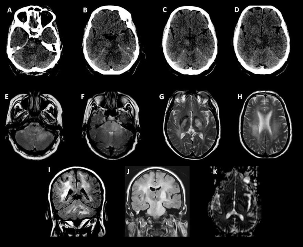 Fig. 9: Gliomatosis cerebri. Non-enhanced brain CT scan (A-D) shows diffuse hypodensity of the white matter of the cerebellum and temporoparietal lobes.