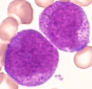 Infection or leukemia (Left Shift or IG