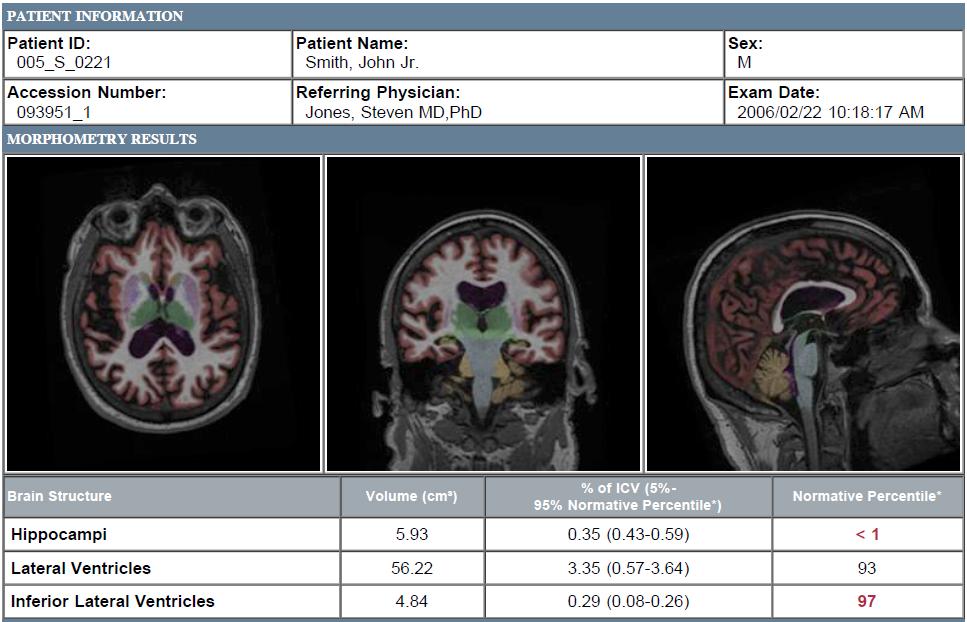 Volumetric MRI Analysis- NeuroQuant
