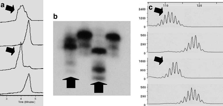 Chromatograms of four different tumor DNAs are shown. The arrows indicate the left-shifted MSI pattern. The arrowed samples show heterozygous alterations.