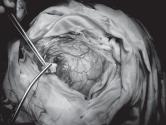 Fig.-8: Per-operative picture of a metastatic brain tumor. adenocarcinoma (40.00%).