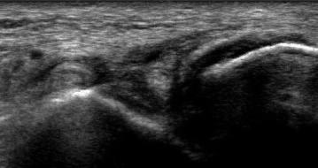 Place the transducer parallel to the examination bed placing its posterior edge over the distal lateral malleolus to image the anterior talofibular