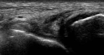 TD TH Talus When distinguishing a partial from a complete tear is difficult, perform a sonographic anterior drawer test by placing the patient prone with