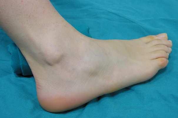 Continue to follow these tendons upwards for approximately 5 cm and downwards through the inframalleolar region.